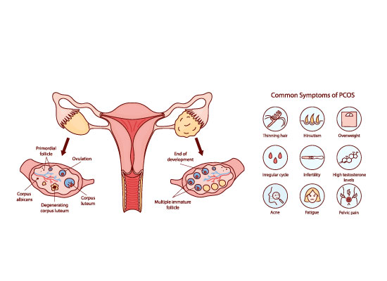 Polikistik Over Sendromu PCOS - (PMOS) ve Hirsutizm Nedir? 